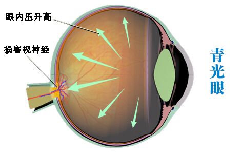 控制青光眼预防失明的10大要点