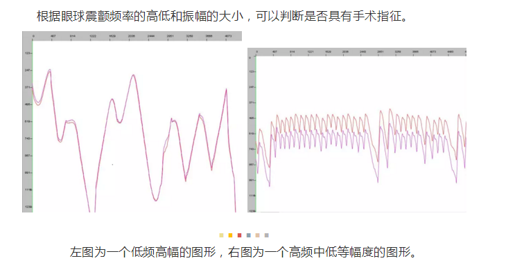 杨东生教授：多方面解析眼球震颤