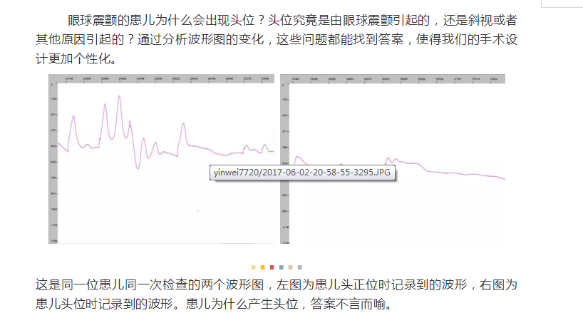 杨东生教授：解析眼球震颤