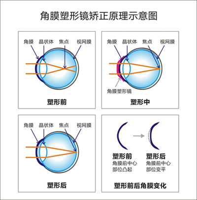 关于角膜塑形镜 家长关心的问题 答案都在这里