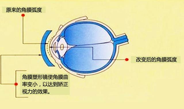 普瑞亮康暑期摘镜总动员—告别多年近视困扰 就在这个夏天