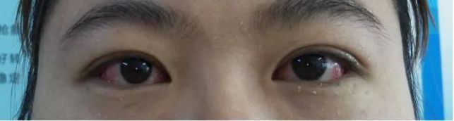 一个全新理念的开启:眼球震颤联合手术