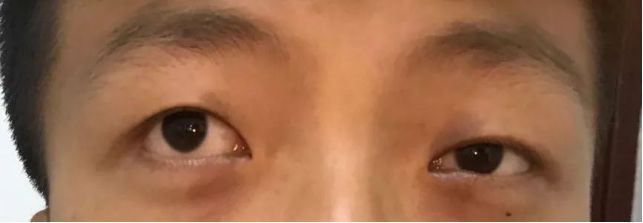 一个全新理念的开启:眼球震颤联合手术