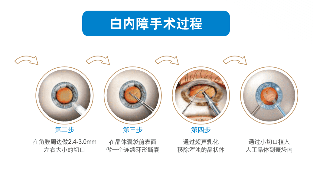 白内障手术费用差异解析:为何花费从几千到几万不等?